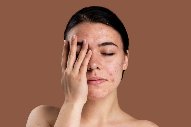 3 Tips Untuk Perawatan Kulit Jerawat