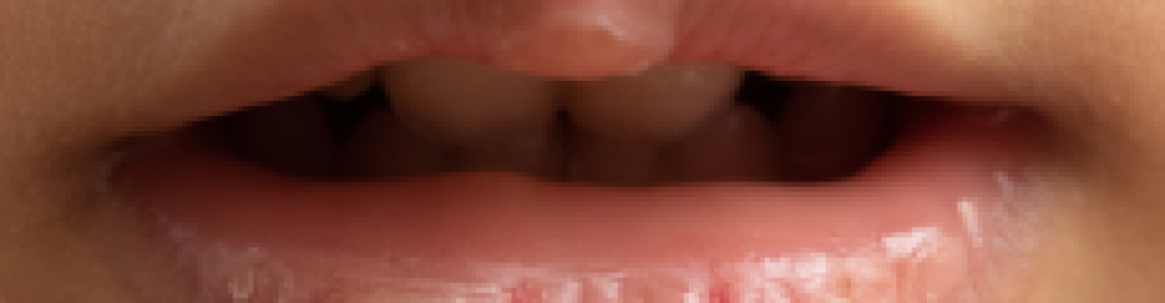 Cara Mengatasi Bibir Kering Dan Pecah-Pecah