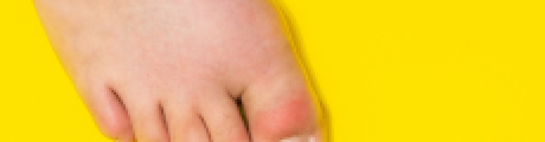 Cara Mengontrol Asam Urat Dengan Pola Hidup & Diet