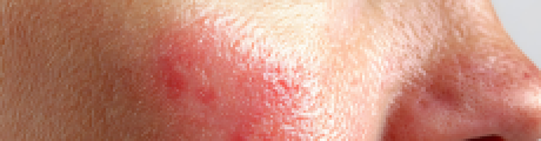 Cara Mengatasi Bruntusan Dengan Skincare