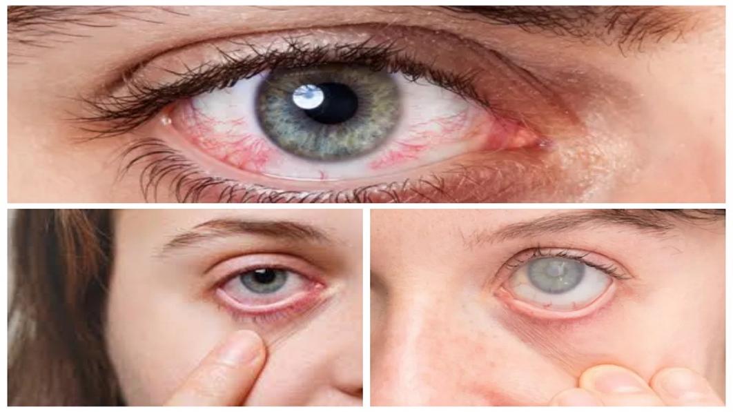 Katarak Sebagai Penyebab Penurunan Penglihatan Pada Usia Dewasa