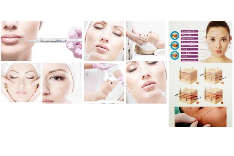 Aesthetic Outlook 2018: Suntik Botox, Filler, atau Tanam Benang menjadi Tren di Dunia