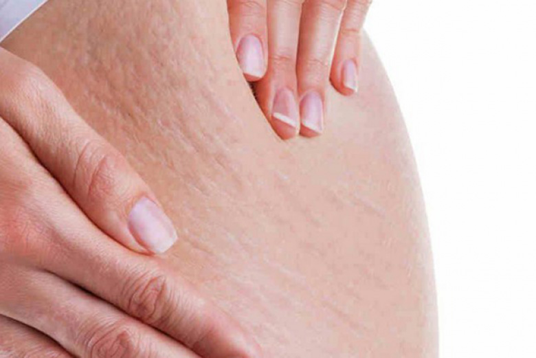 6 Tips Ringan Mengatasi Selulit
