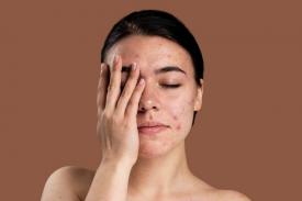 Gambar Artikel 3 Tips Untuk Perawatan Kulit Jerawat