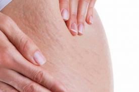 6 Tips Ringan Mengatasi Selulit
