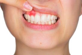 Kenali Penyakit Periodontitis Demi Kesehatan Gigi dan Mulut Anda