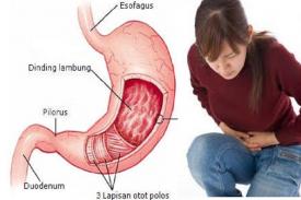 Gambar Artikel Jangan Main-main dengan Asam Lambung! Ini Makanan yang Dianjurkan Apabila Asam Lambung Naik