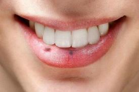 Gambar Artikel Penyebab Bibir Menjadi Gelap Tanpa Disadari
